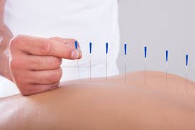 ACUPUNCTURE THERAPY IN DHAKA 