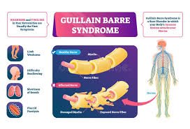 Guillain-Barre Syndrome (GBS)